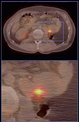 Kidney Cancer Treatment Surgery